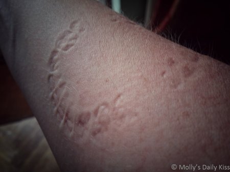 Bite marks on Molly's arm